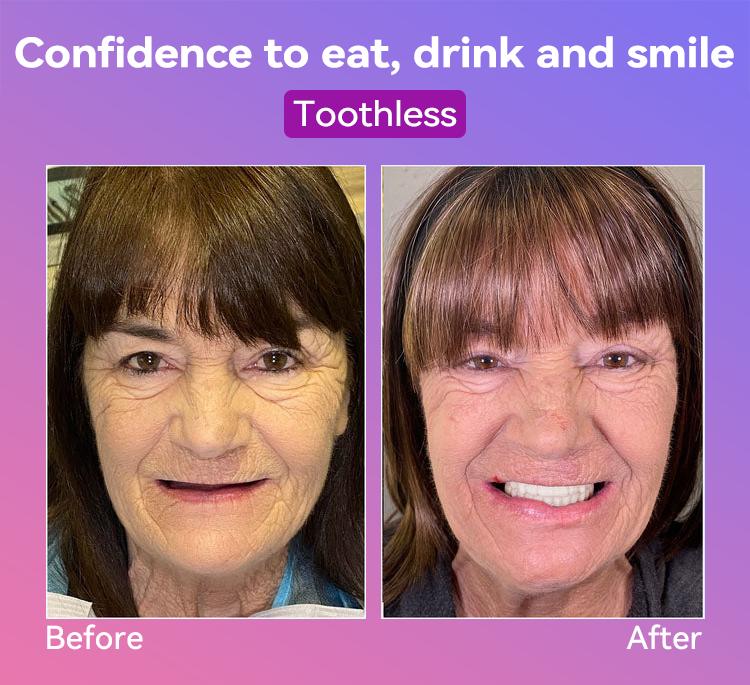 𝐉𝐚𝐬𝐬𝐞𝐞𝐦® Latest Premium Comfort Dentures💖 (High-End Dentures, Easy to Wear - Limited Time 70% Discount)🔥