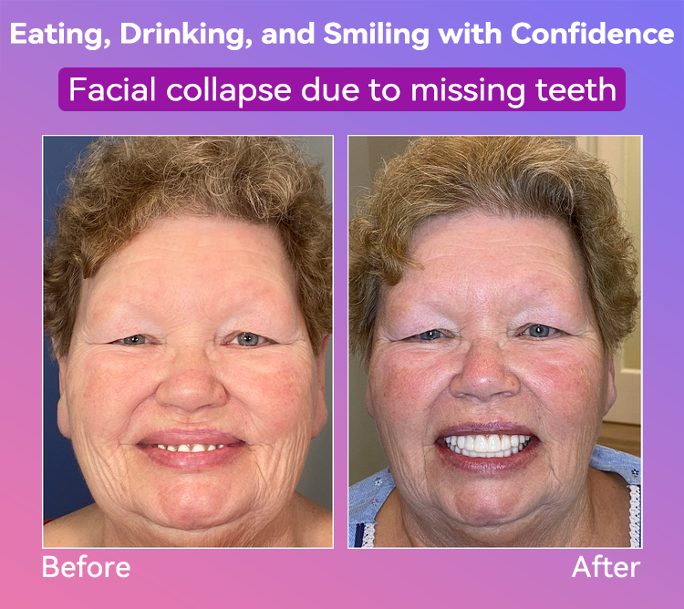 𝐉𝐚𝐬𝐬𝐞𝐞𝐦® Latest Premium Comfort Dentures💖 (High-End Dentures, Easy to Wear - Limited Time 70% Discount)🔥