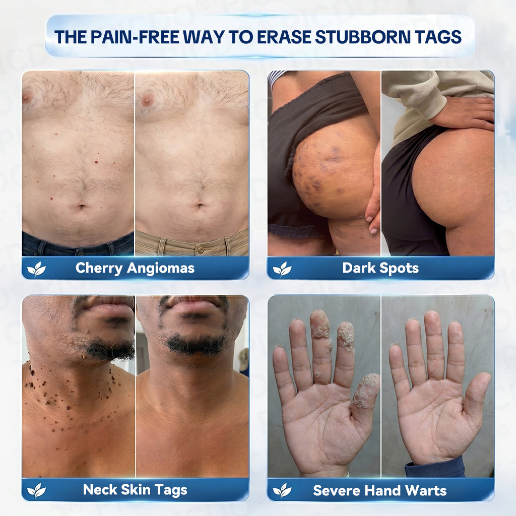 𝐏𝐢𝐜𝐝𝐨® 7-𝐃𝐚𝐲 𝐒𝐤𝐢𝐧 𝐓𝐚𝐠 & 𝐒𝐩𝐨𝐭 𝐄𝐫𝐚𝐬𝐞𝐫 𝐂𝐫𝐞𝐚𝐦🩵 (Zero Pain, Zero 𝐒𝐜𝐚𝐫𝐬 Formula) 💪