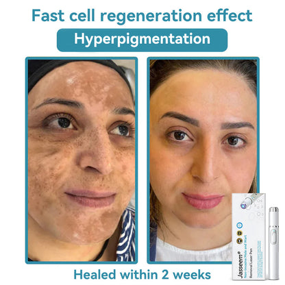 𝐉𝐚𝐬𝐬𝐞𝐞𝐦® Medical-Grade Laser Pen 💕 (Powered by CO₂ laser technology – effectively removes moles, warts, skin tags, pigmentation spots, and other skin imperfections)🏆