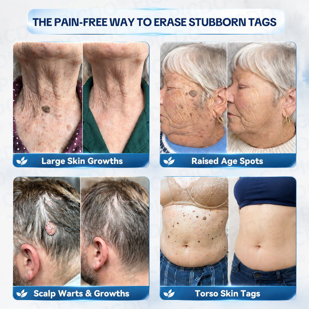 𝐏𝐢𝐜𝐝𝐨® 7-𝐃𝐚𝐲 𝐒𝐤𝐢𝐧 𝐓𝐚𝐠 & 𝐒𝐩𝐨𝐭 𝐄𝐫𝐚𝐬𝐞𝐫 𝐂𝐫𝐞𝐚𝐦🩵 (Zero Pain, Zero 𝐒𝐜𝐚𝐫𝐬 Formula) 💪