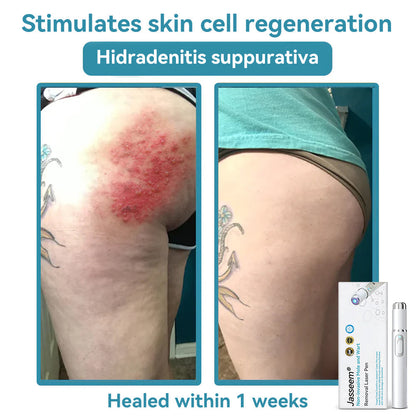 𝐉𝐚𝐬𝐬𝐞𝐞𝐦® Medical-Grade Laser Pen 💕 (Powered by CO₂ laser technology – effectively removes moles, warts, skin tags, pigmentation spots, and other skin imperfections)🏆