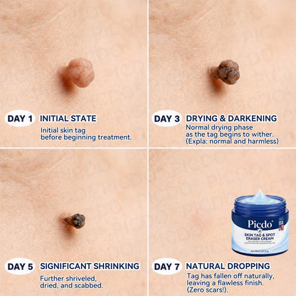 𝐏𝐢𝐜𝐝𝐨® 7-𝐃𝐚𝐲 𝐒𝐤𝐢𝐧 𝐓𝐚𝐠 & 𝐒𝐩𝐨𝐭 𝐄𝐫𝐚𝐬𝐞𝐫 𝐂𝐫𝐞𝐚𝐦🩵 (Zero Pain, Zero 𝐒𝐜𝐚𝐫𝐬 Formula) 💪