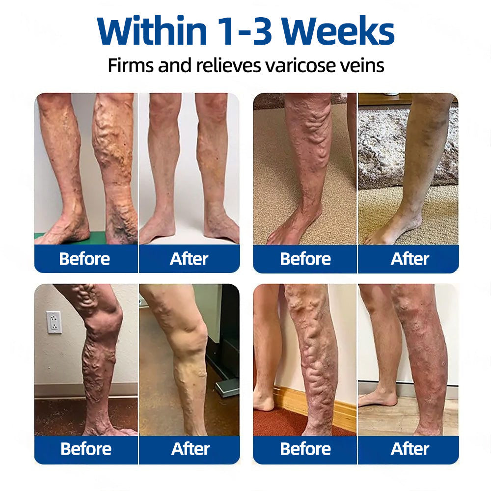 🎁🎁𝐅𝐥𝐨𝐫𝐢𝐬𝐦𝐚® 𝐕𝐞𝐢𝐧𝐓𝐚𝐫𝐠𝐞𝐭 𝐌𝐢𝐜𝐫𝐨𝐧𝐞𝐞𝐝𝐥𝐞 𝐏𝐚𝐭𝐜𝐡⚡Instant Relief, Long-Term Results