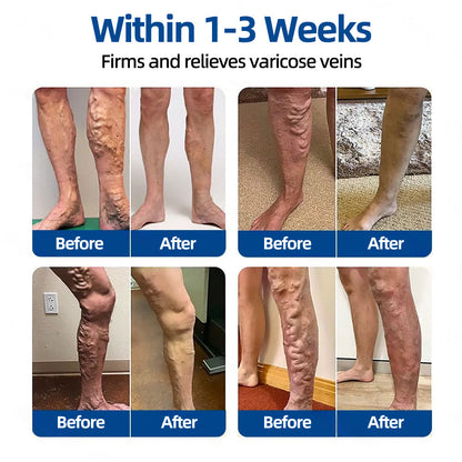 🎁🎁𝐅𝐥𝐨𝐫𝐢𝐬𝐦𝐚® 𝐕𝐞𝐢𝐧𝐓𝐚𝐫𝐠𝐞𝐭 𝐌𝐢𝐜𝐫𝐨𝐧𝐞𝐞𝐝𝐥𝐞 𝐏𝐚𝐭𝐜𝐡⚡Instant Relief, Long-Term Results