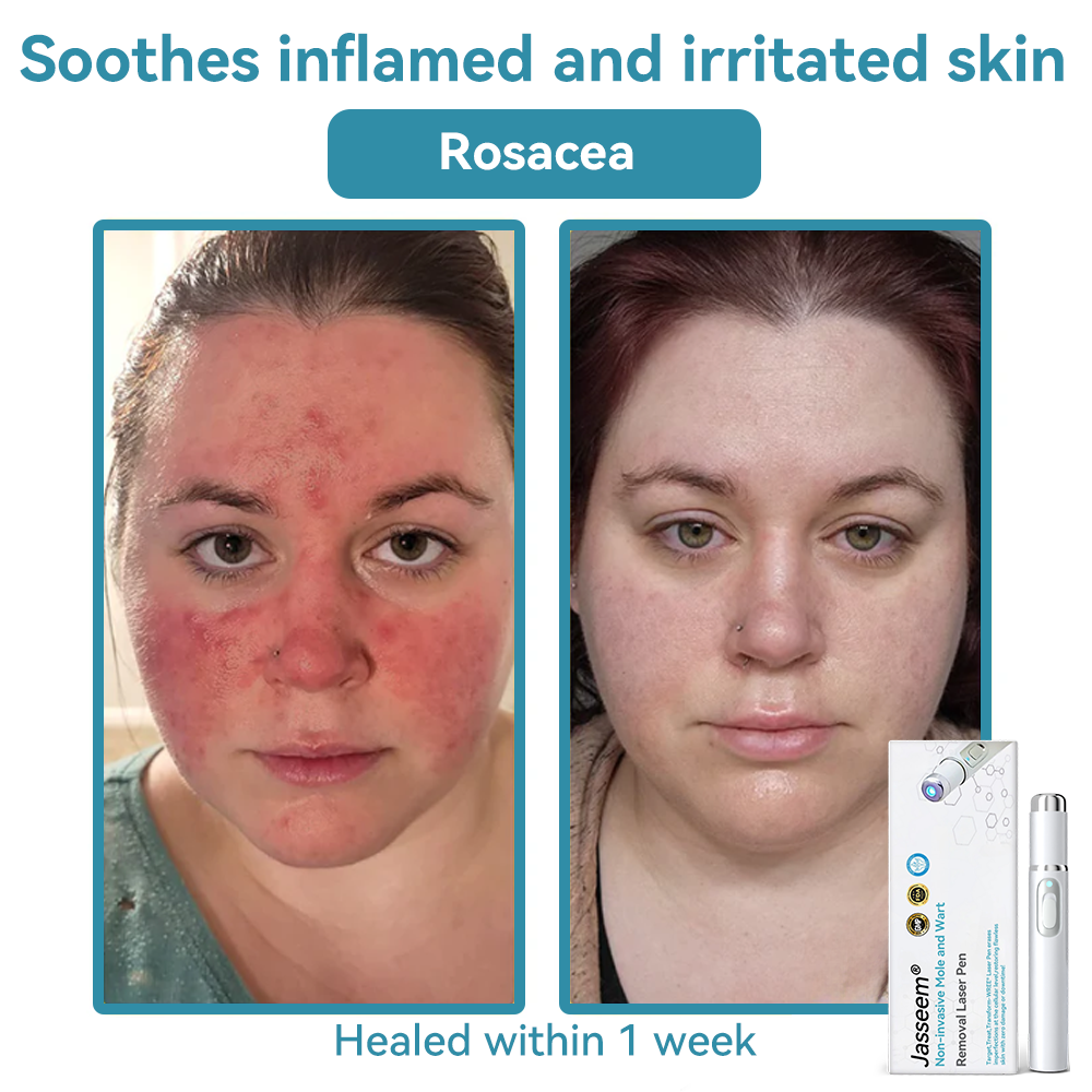 𝐉𝐚𝐬𝐬𝐞𝐞𝐦® Medical-Grade Laser Pen 💕 (Powered by CO₂ laser technology – effectively removes moles, warts, skin tags, pigmentation spots, and other skin imperfections)🏆