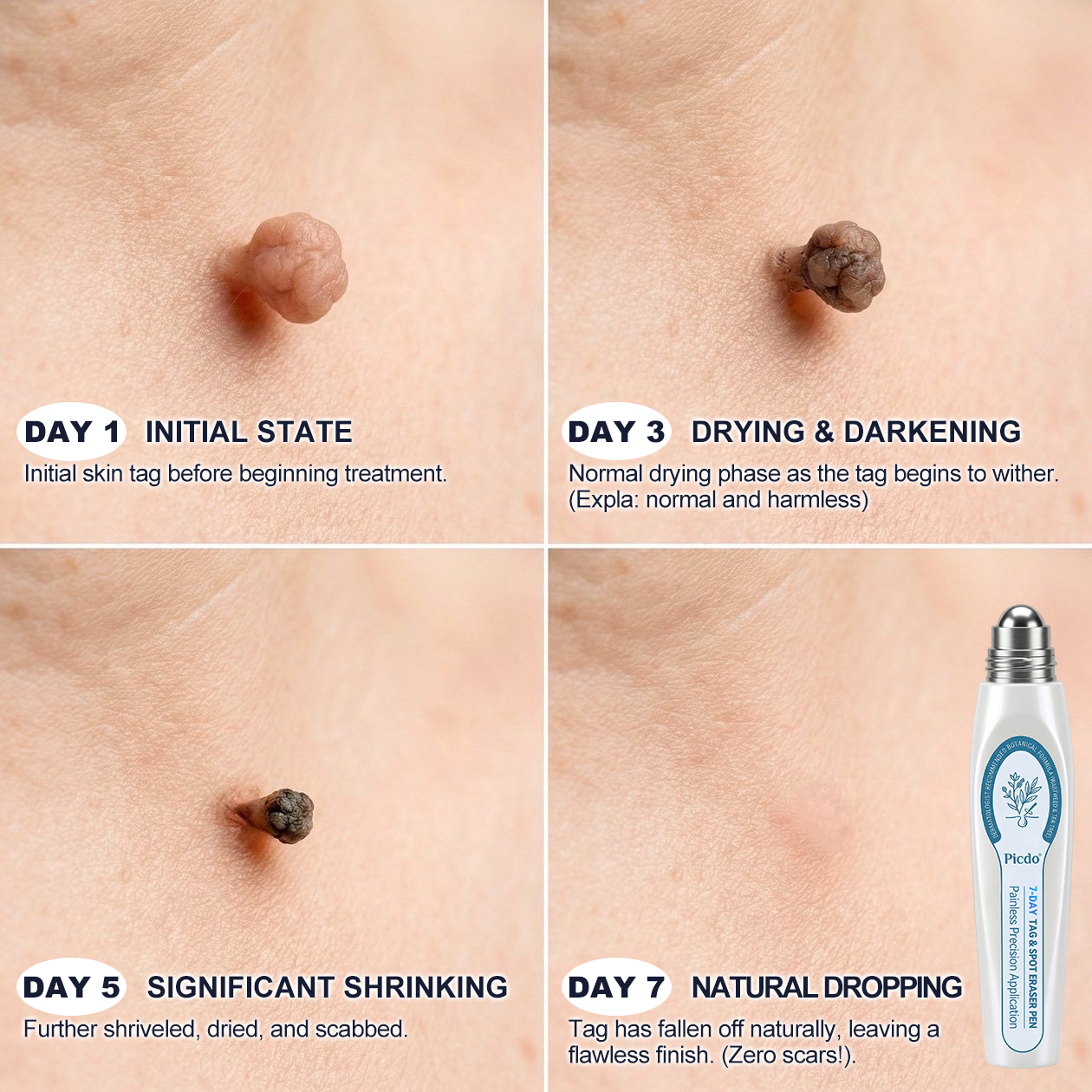 𝐎𝐟𝐟𝐢𝐜𝐢𝐚𝐥 𝐁𝐫𝐚𝐧𝐝 𝐒𝐭𝐨𝐫𝐞 |🧿𝐏i𝐜𝐝o® 7-𝐷𝑎𝑦 𝗧𝐚𝐠 & 𝗦𝗽𝐨𝐭 𝐄𝐫𝒂𝒔𝒆𝒓(Zero Pain, Zero 𝐒𝐜𝐚𝒓𝒔 Rollerball)🌀