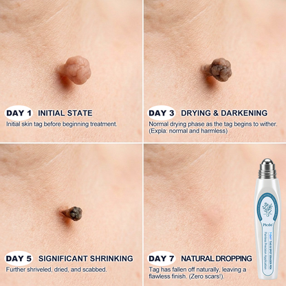 𝐎𝐟𝐟𝐢𝐜𝐢𝐚𝐥 𝐁𝐫𝐚𝐧𝐝 𝐒𝐭𝐨𝐫𝐞 |🧿𝐏i𝐜𝐝o® 7-𝐷𝑎𝑦 𝗧𝐚𝐠 & 𝗦𝗽𝐨𝐭 𝐄𝐫𝒂𝒔𝒆𝒓(Zero Pain, Zero 𝐒𝐜𝐚𝒓𝒔 Rollerball)🌀